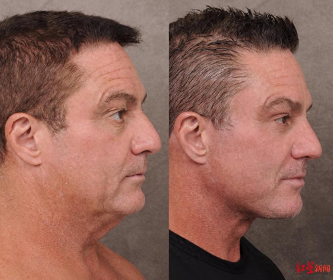 美國科技男也愛上“微整容”!在硅谷,若看起來老了會被認為“無關(guān)緊要”